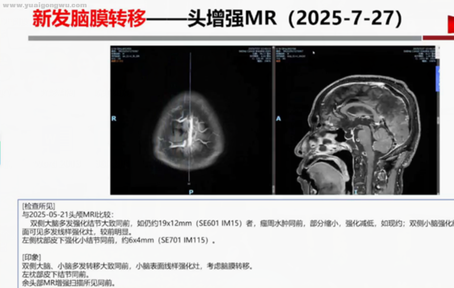 脑膜1.png